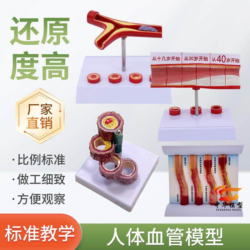 心脑血管堵塞模型关节血栓血液浓度脂肪病理粥样硬化人体解剖教具