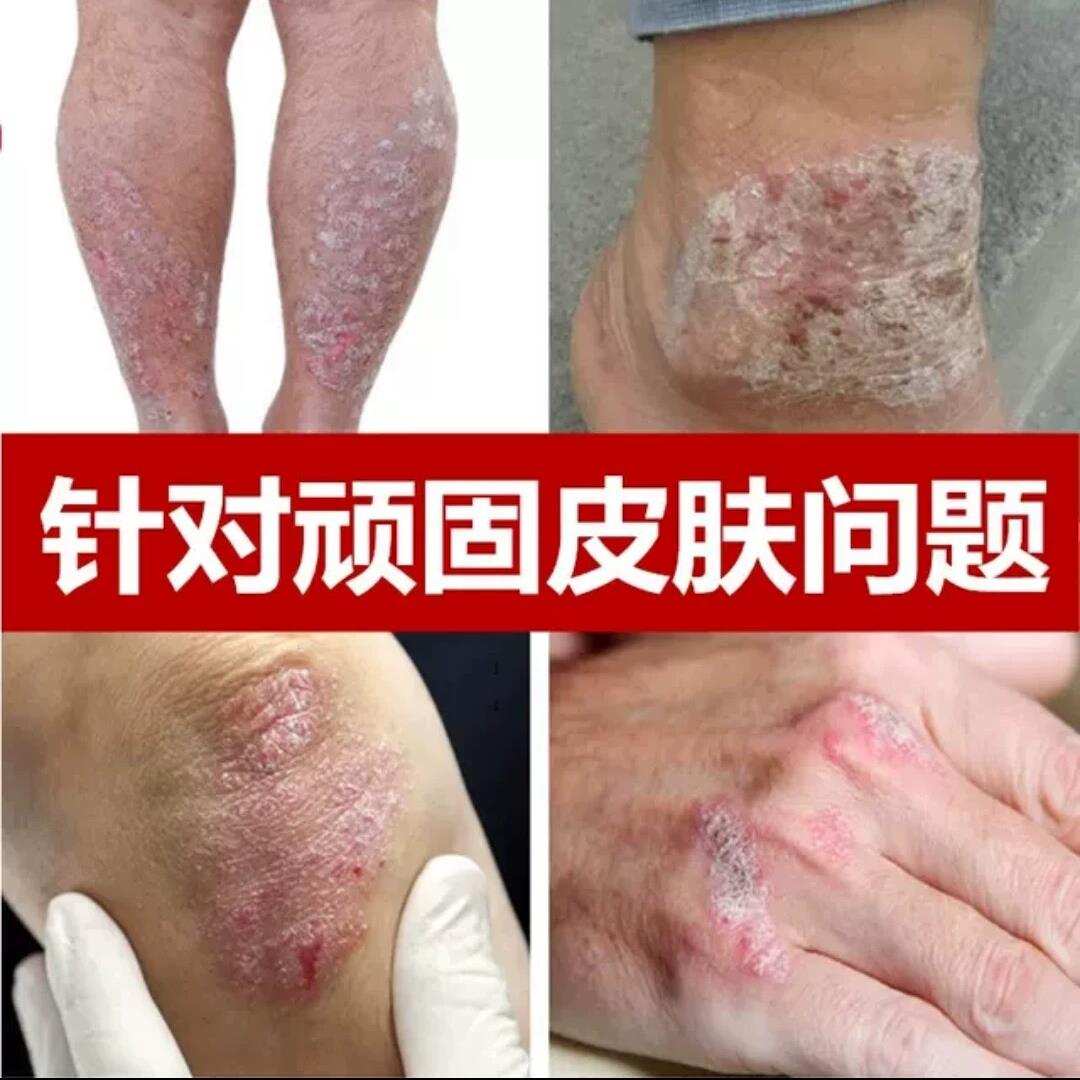 去全身大小腿脚腕起皮头皮头部顽固专用外用膏止痒