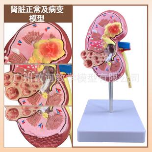 人体肾解剖模型 病变肾脏模型 肾脏模型 人体内脏器官解剖模型