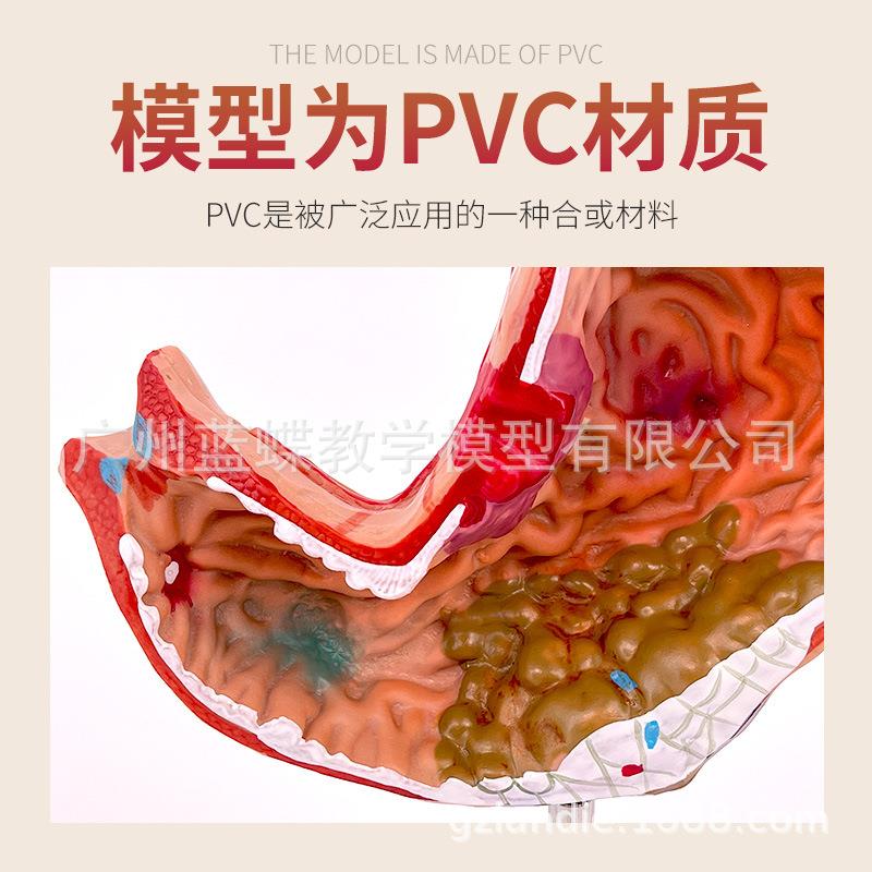 病理胃模型 人体胃的穿孔 病态胃模型 消化科 胃冠状剖面解剖放大