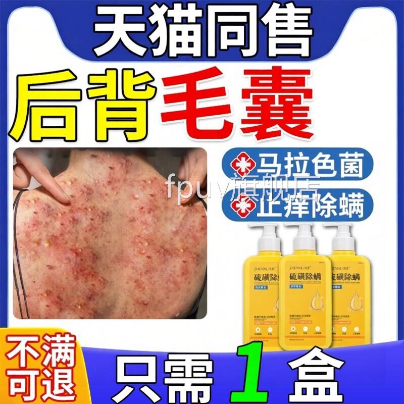 马拉色菌药膏治后背长痘痘毛囊疗专用二化硒洗剂药膏沐浴露硫FFFP