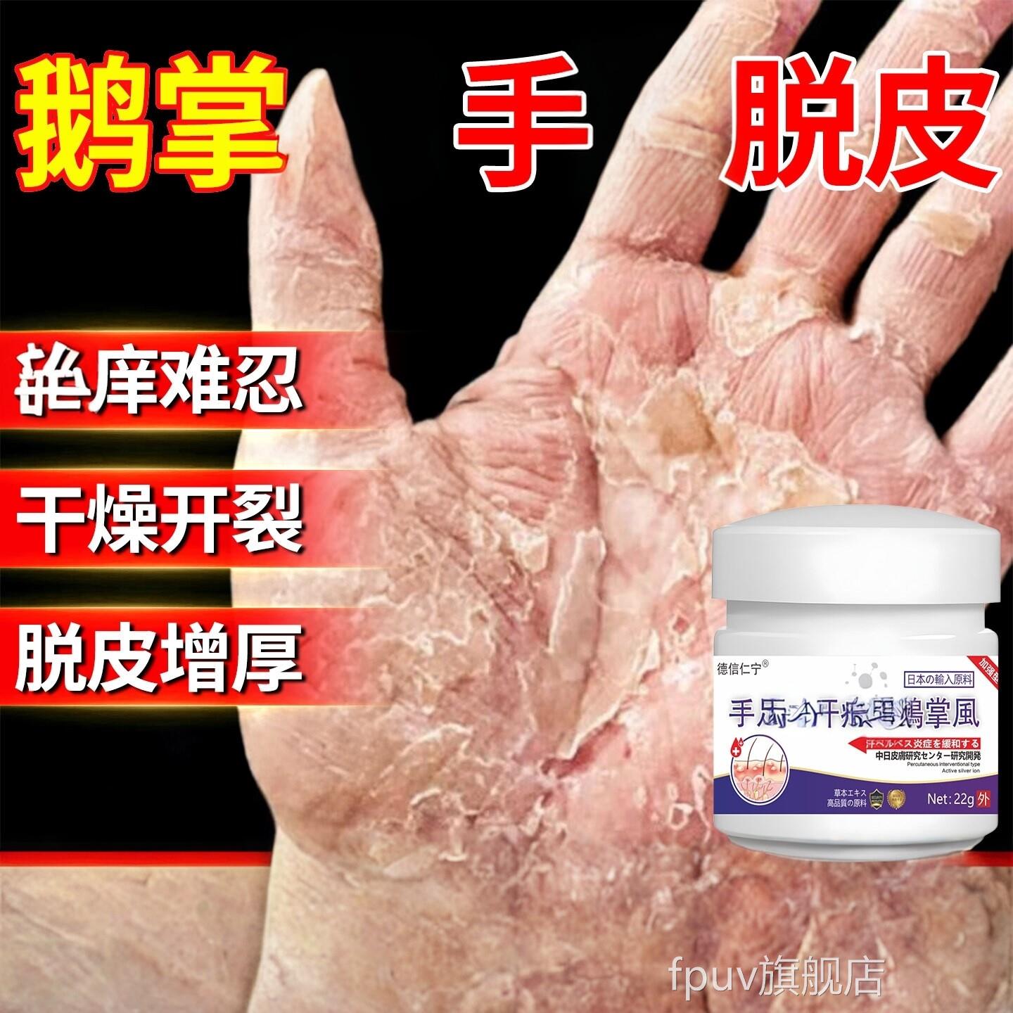 鹅掌用风手膏脱湿皮干裂真菌感染角化型去手部角化皲裂膏FPUV旗舰