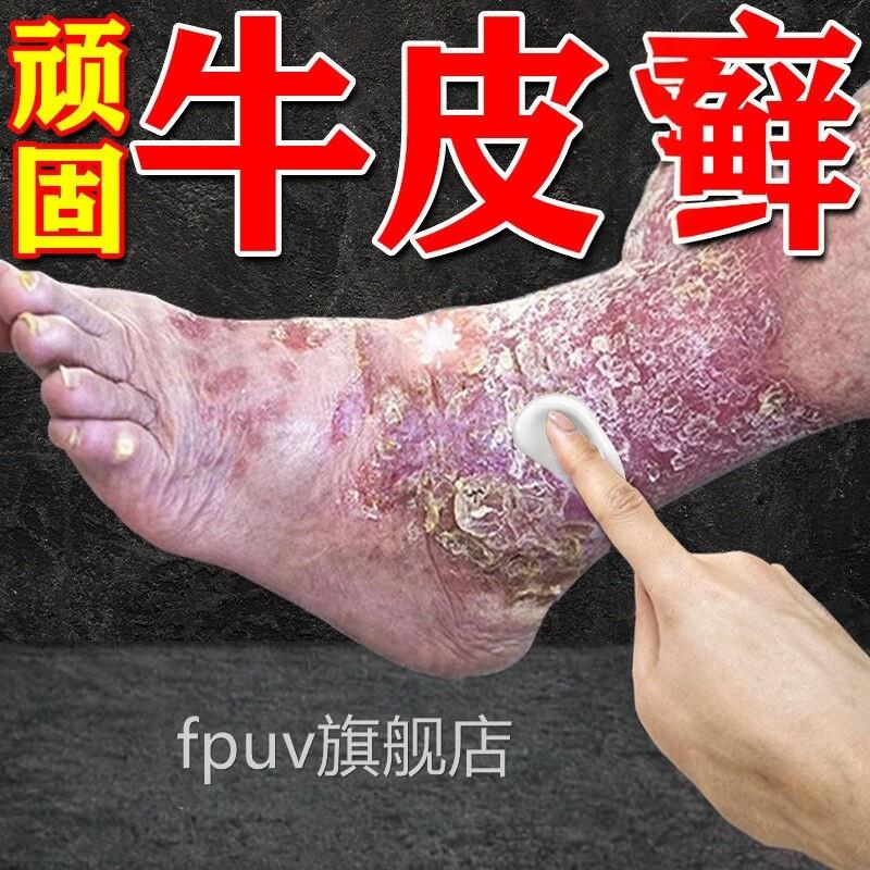 日本进口疗顽固性牛皮银屑效膏药皮肤真用菌感染杀菌FPUV旗舰店