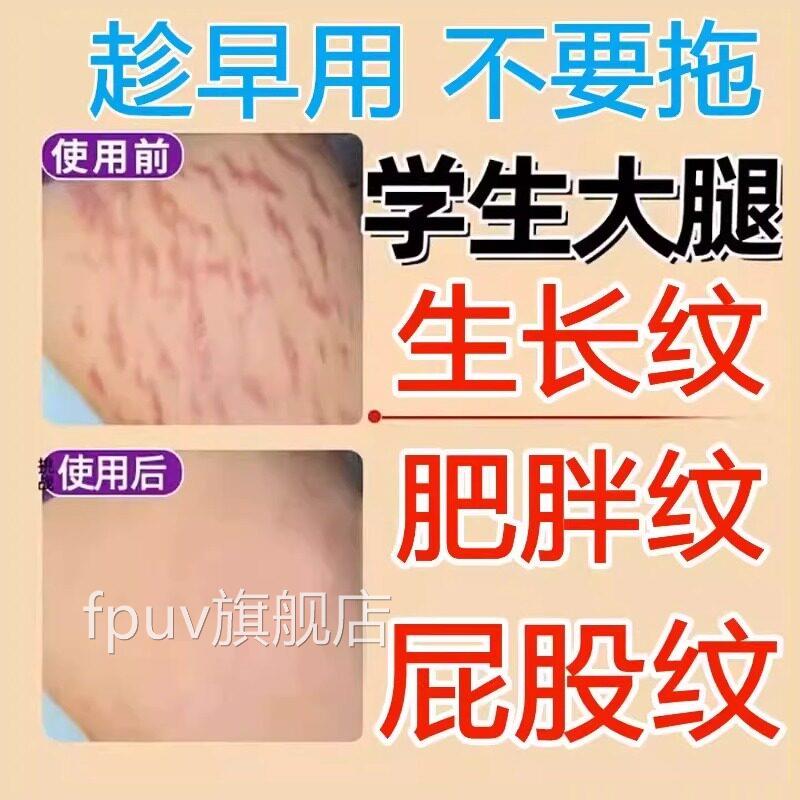 淡纹膏青少年去祛肥胖纹女生修复霜生男长纹消除大腿膏淡化膨胀纹