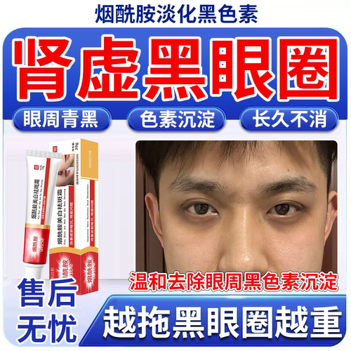 【肾虚黑眼圈】黑色素沉淀去除