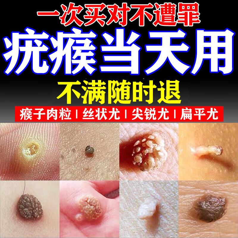 索扁平疣见严去除膏荣药膏丝状疣祛小肉粒瘊子一抹灵去除神器膏药