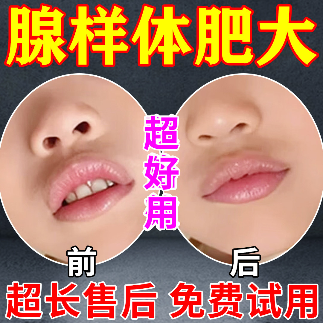 宁腺线灵贴腺样体贴肥大面容矫正器中药贴儿童张嘴睡觉专用贴调理