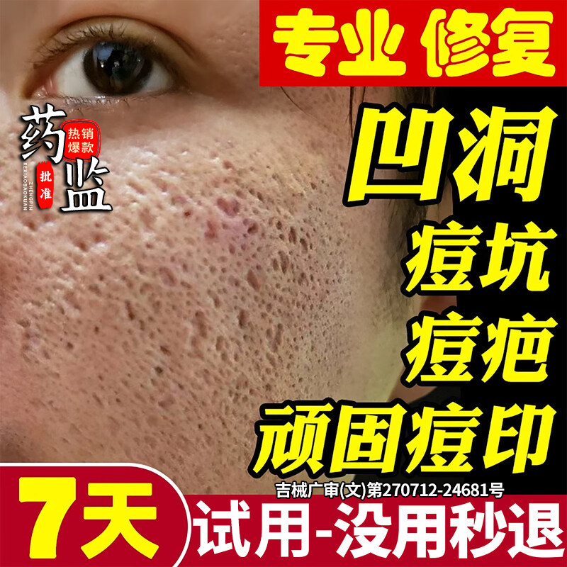 祛痘印痘坑修复膏淡化去痘印痘疤