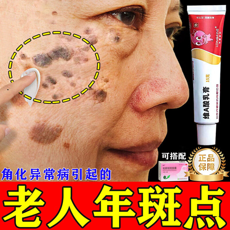 氟轻松维a酸乳膏氢醌医用祛斑老年黄褐斑雀斑官方正品旗舰店专用