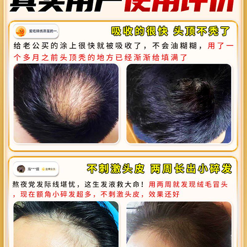 头发生长剂,快速生长,脂溢性,抗脱发,头发生长,浓密的头发,振兴毛