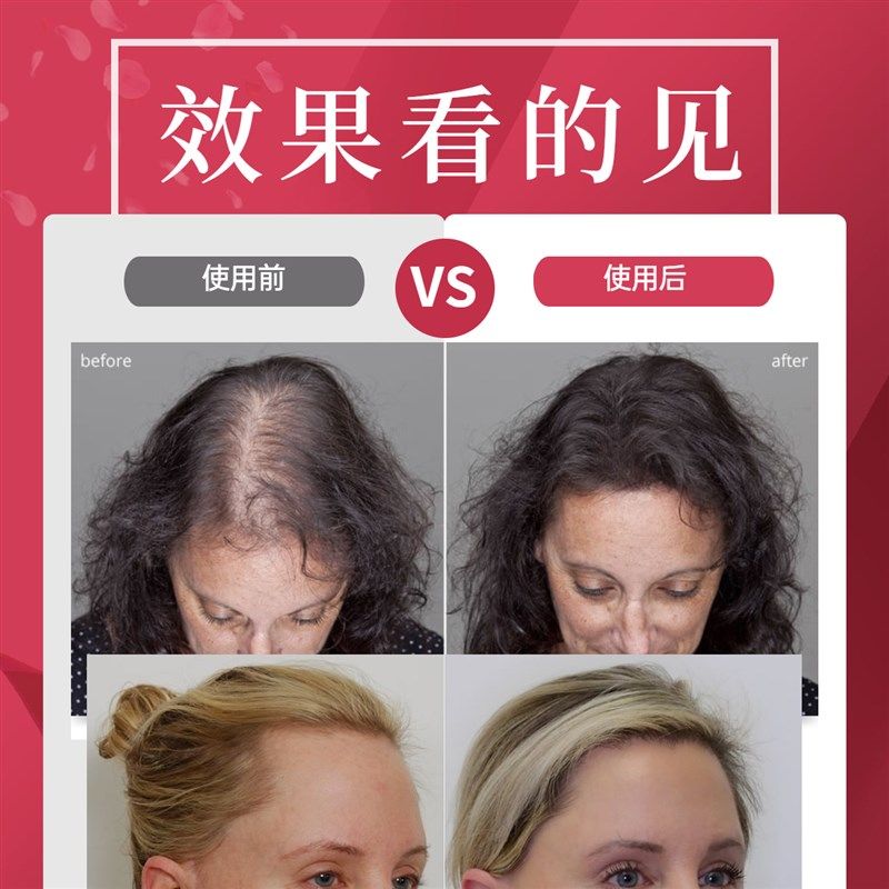 AGA生发液增长液增发密发生发剂发际线育发液女生修复防脱精华液