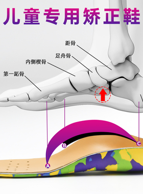 儿童夏季内外八字矫正鞋垫扁平足外翻矫正垫XO型腿足弓矫形器防臭