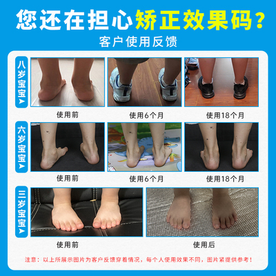 儿童夏季内外八字矫正鞋垫扁平足外翻矫正垫XO型腿足弓矫形器防臭
