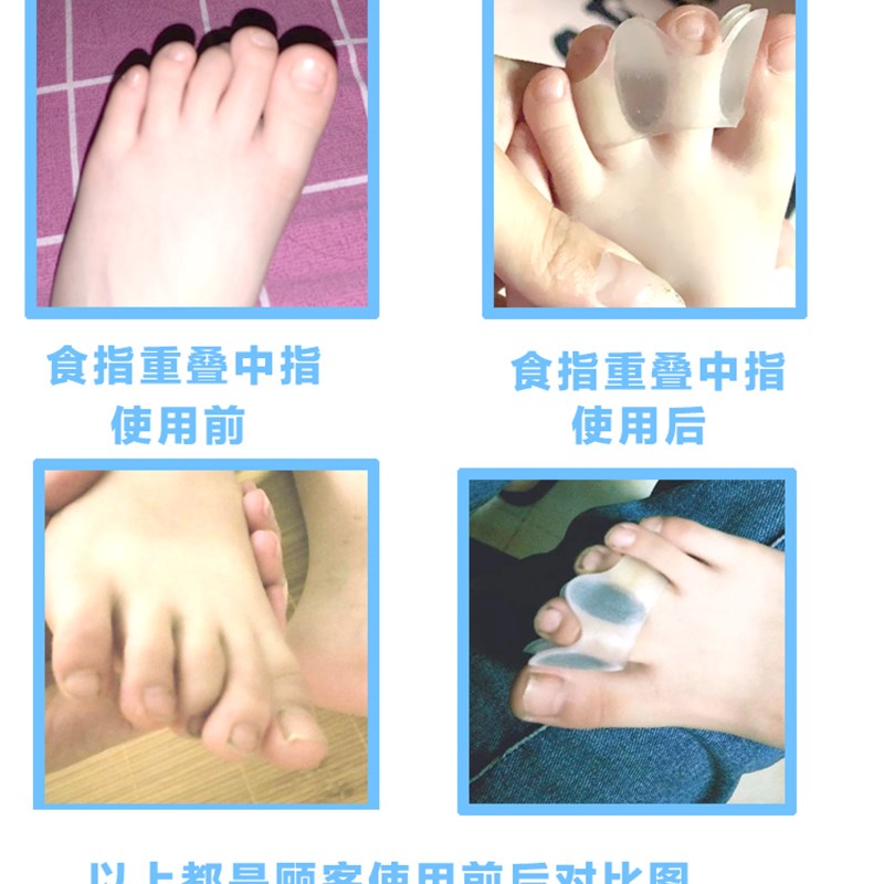 儿童脚趾矫正器中指食指重叠第三趾弯曲小拇指内外翻可穿鞋分趾器