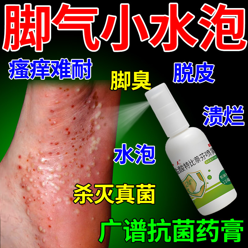 脚气喷雾脚底水泡痒止痒脱皮杀菌真菌感染瘙痒盐酸特比萘芬喷雾剂