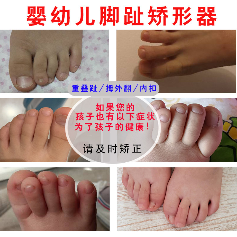 小孩子脚趾矫正器婴幼儿拇趾外翻矫形器宝宝分趾器重叠趾分离器内