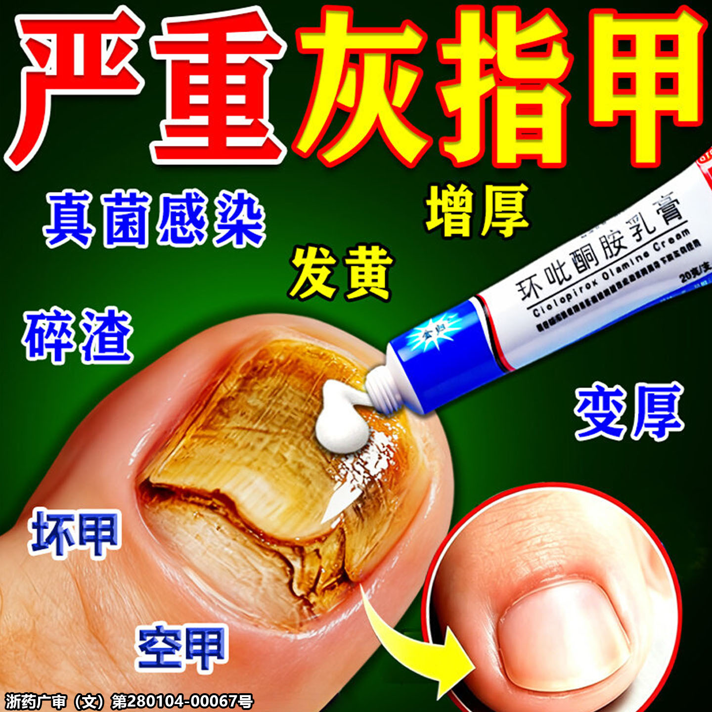治疗灰指甲亮甲真菌感染专用特第效药一名环吡酮胺乳膏官方旗舰店