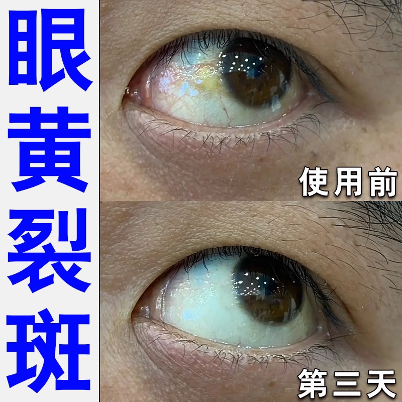 眼睑裂斑眼水去除黄斑病变眼睑周红肿疼痛眼白发黄斑凸起有异物