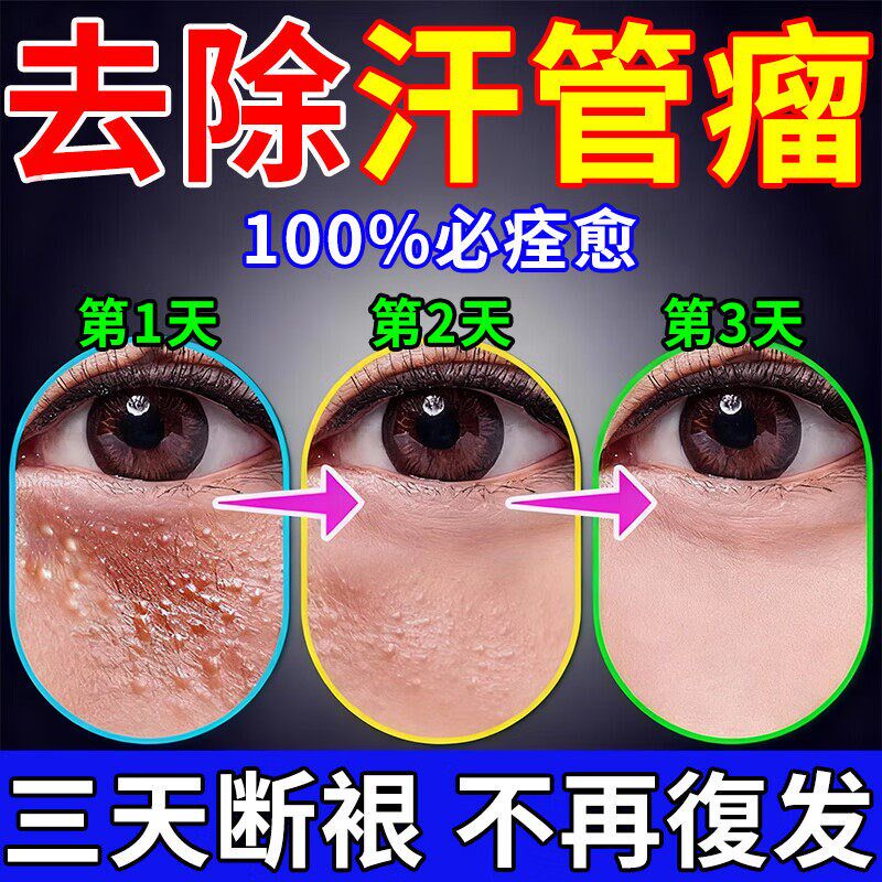 汗管瘤眼部去除神器脂肪粒扁平治眼部周围粟丘疹油脂专用的膏药