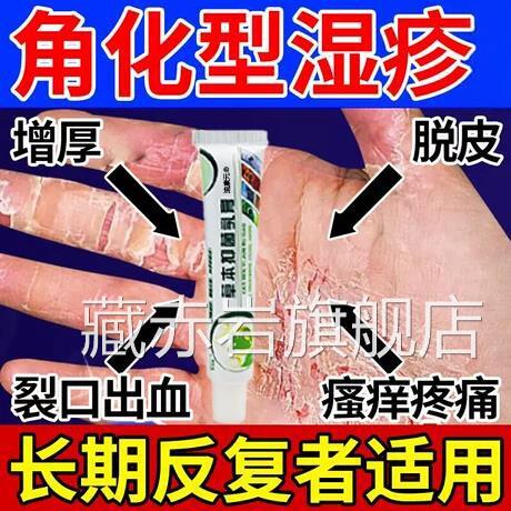 角化型湿疹手癣膏染鹅掌风脱皮干裂瘙痒真菌感手掌粗糙增厚消皮炎