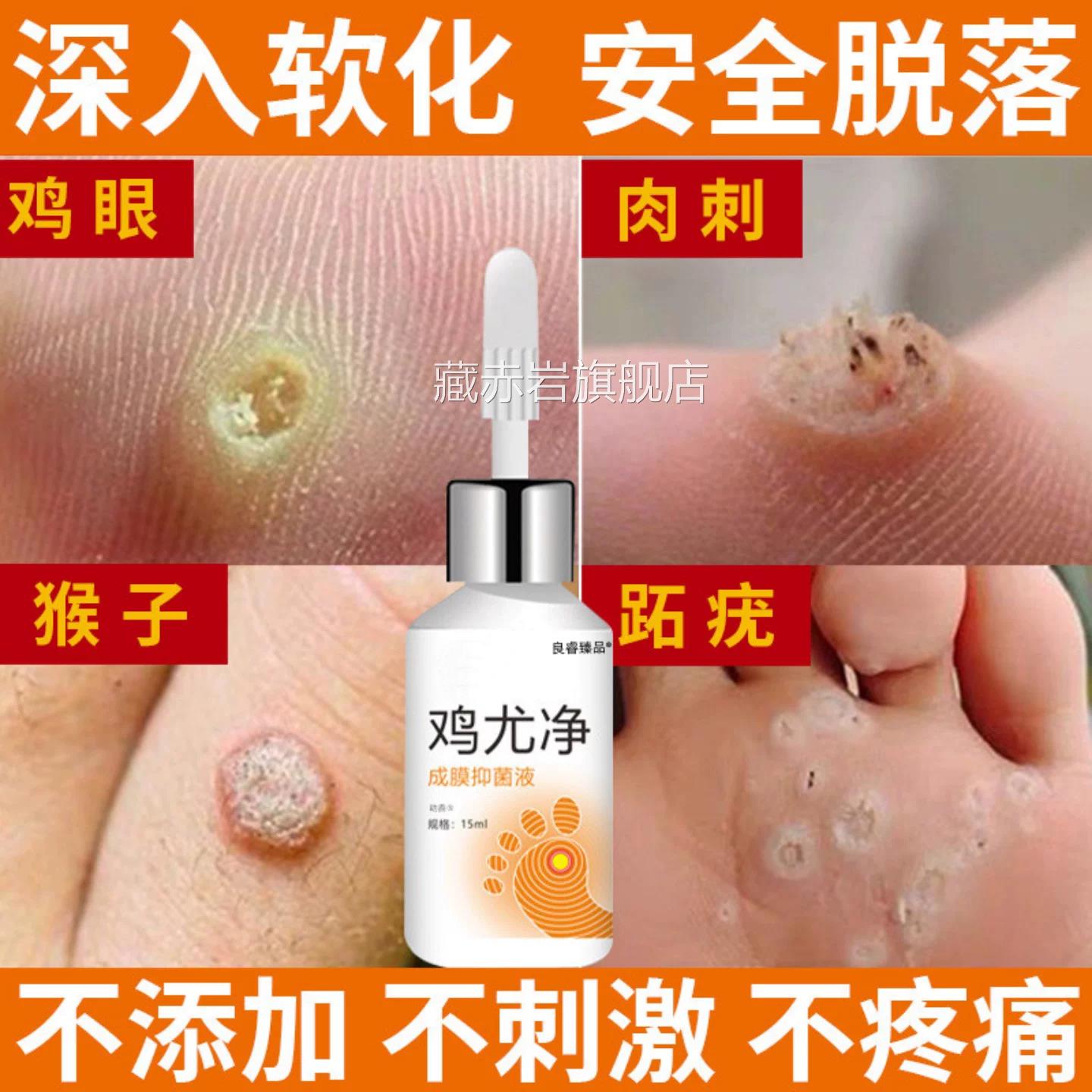 跖疣病毒疣液连根拔专用贴膏趾疣水冷冻除疣氮根去脚底疣除颜慈安