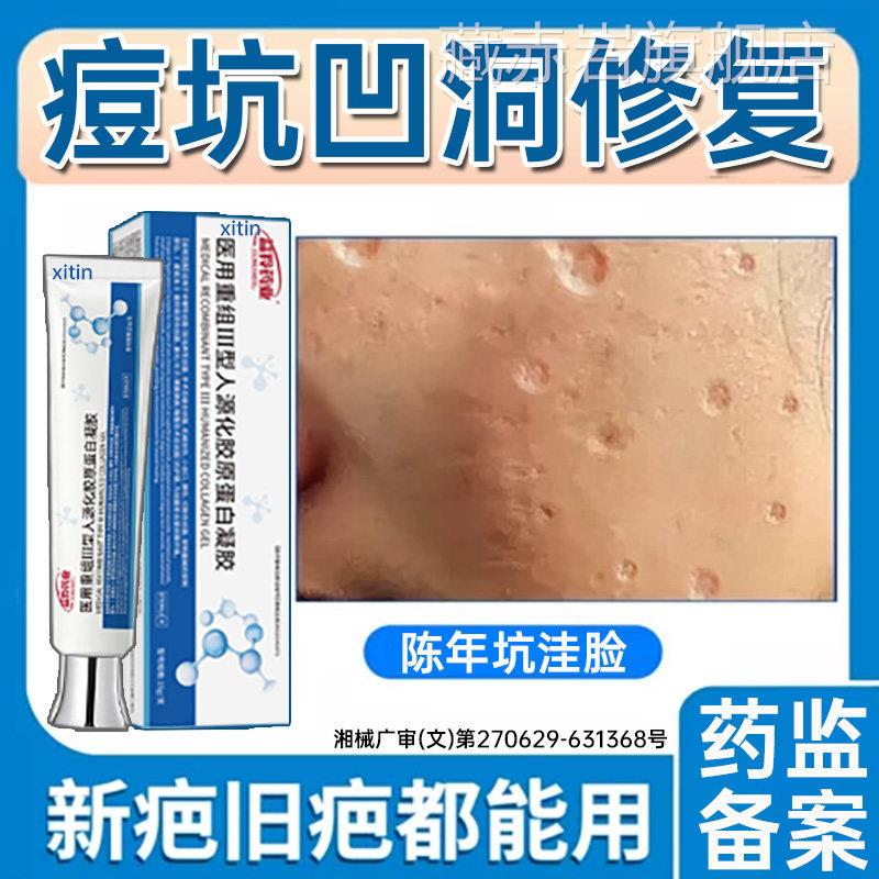 痘坑凹洞修复生长因子痘印修复男医用型淡化陷疤痕黑色素沉凹淀UU