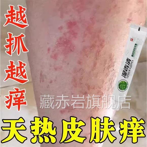 夏天小毒腿痒湿成人止膏出汗身上痒天热皮肤疹瘙痒热疙瘩红疹热痒