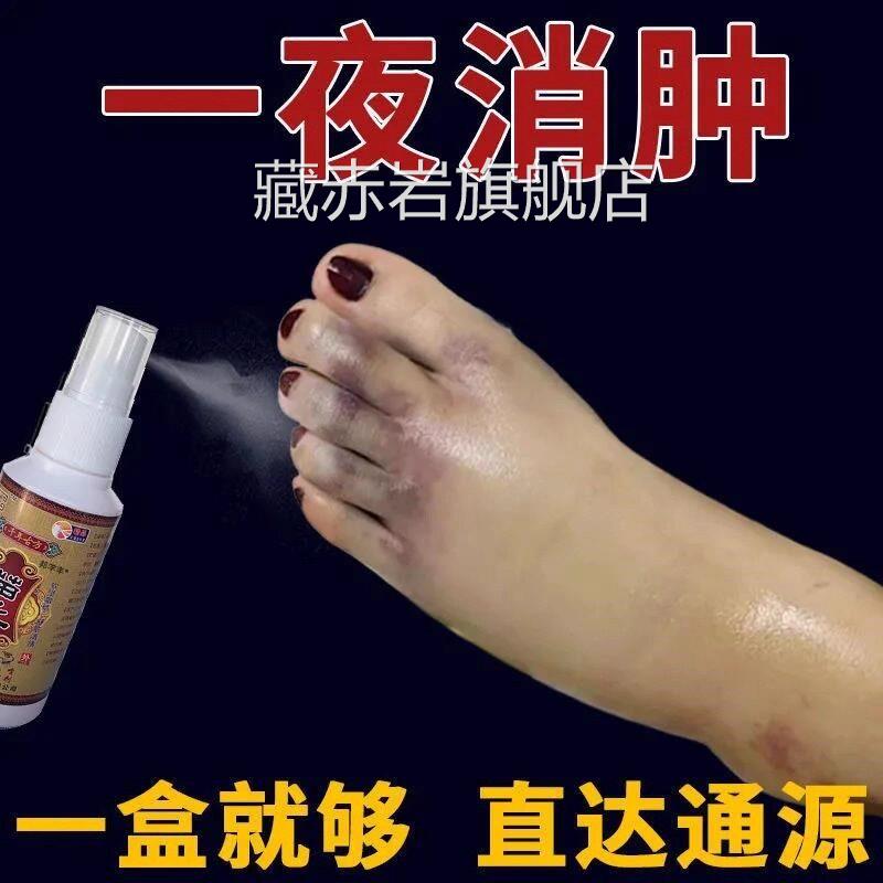 去水肿消效特的药老人脚肿消肿的药消肿止痛喷剂活血化瘀外用专用