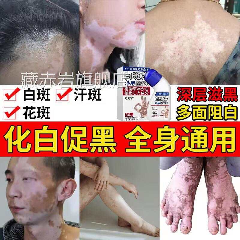 白癜膏风外用白斑净黑色素遮盖液促补骨脂酚祛白斑净汗斑花斑专用