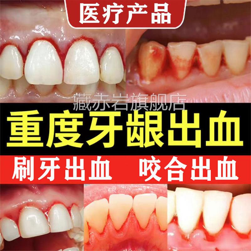 云南白药牙膏牙G周炎牙龈出血专用双效抗敏官方旗舰店正品去口臭X