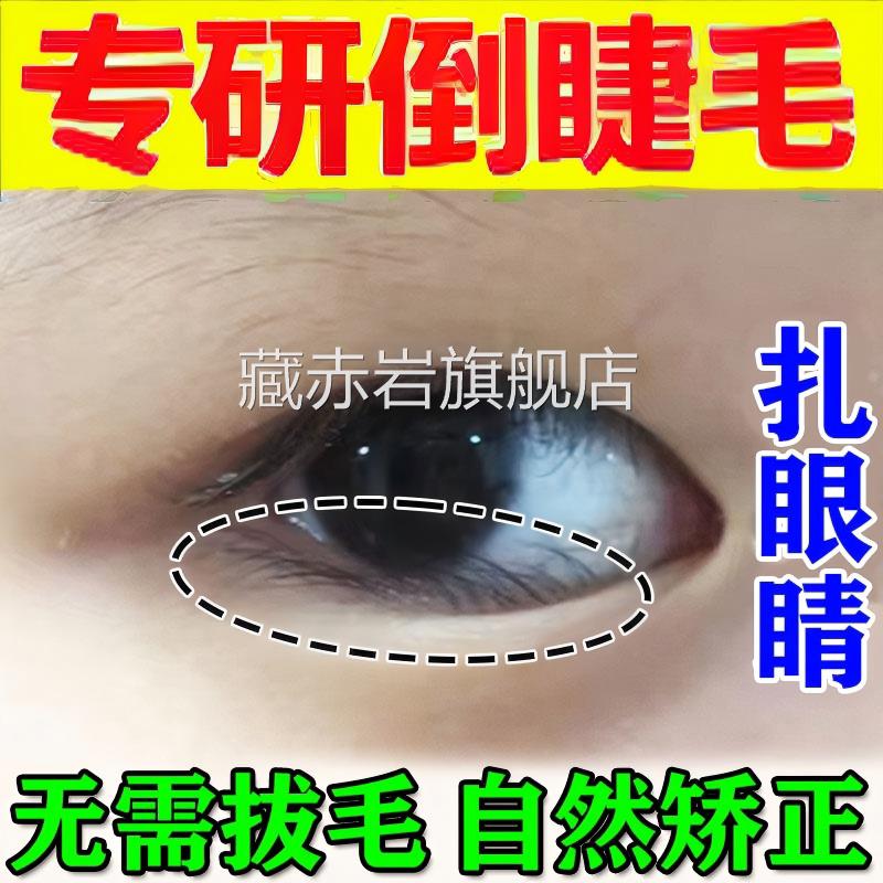 倒睫毛矫童正贴成人婴儿睫毛倒长眼睑下垂提拉眼皮儿专用神器正品