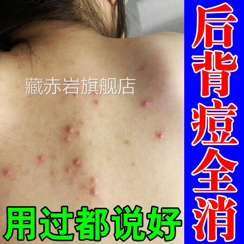 马拉色菌前胸后背祛痘身上背部祛痘除螨去痘膏痱子红疹红起疙瘩痒