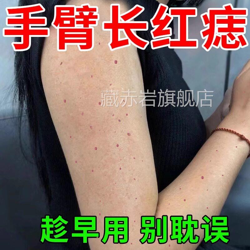 血管瘤药膏樱桃状点口脖子胸红痣血痣蜘蛛痣去除身上红点痣套装GX