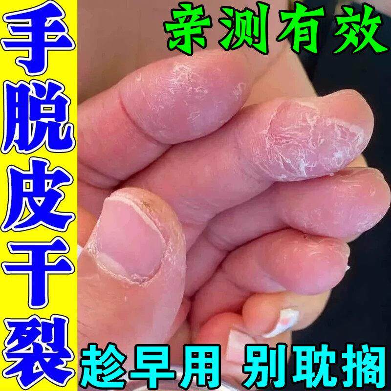 手脱皮干裂真菌感染手上起皮干燥掉皮专用真菌蜕皮脚底开裂护手霜