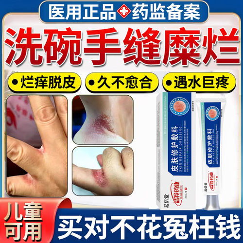 洗碗碰水手指缝溃烂药膏烂手丫糜烂