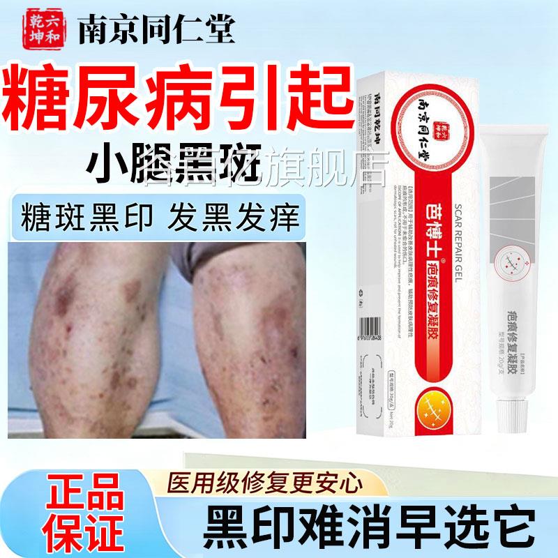 糖尿病小腿黑斑去黑色素沉淀修复膏引起胫前腿发黑烂去足除糖斑谷