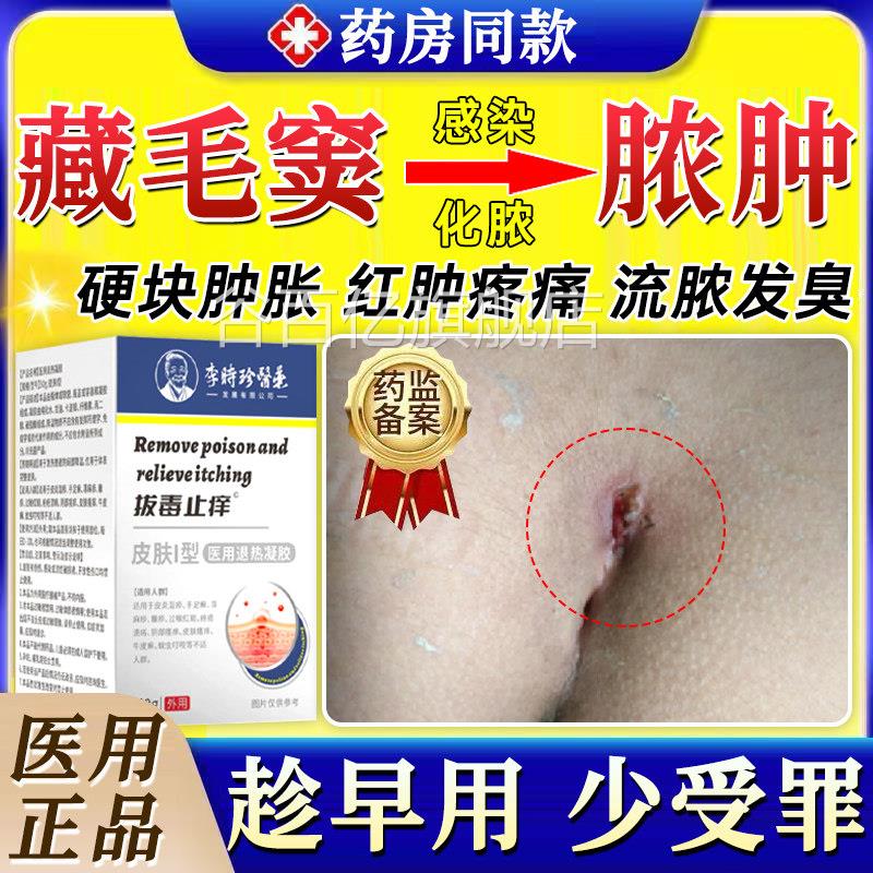 藏毛窦药膏感染化脓脓肿囊肿骶骨尾肛硬疙瘩坐疮毛门囊炎拔毒拔GX