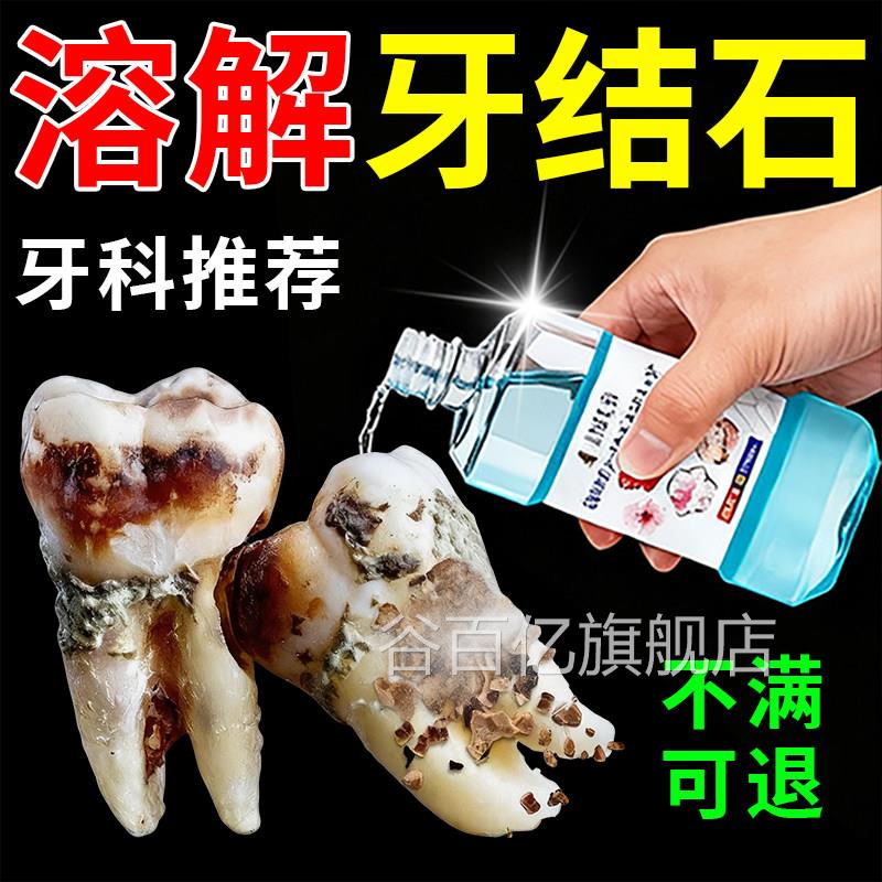 医用型去牙结石效溶解剂牙石速清理漱口水洗牙水牙垢清除去除神器