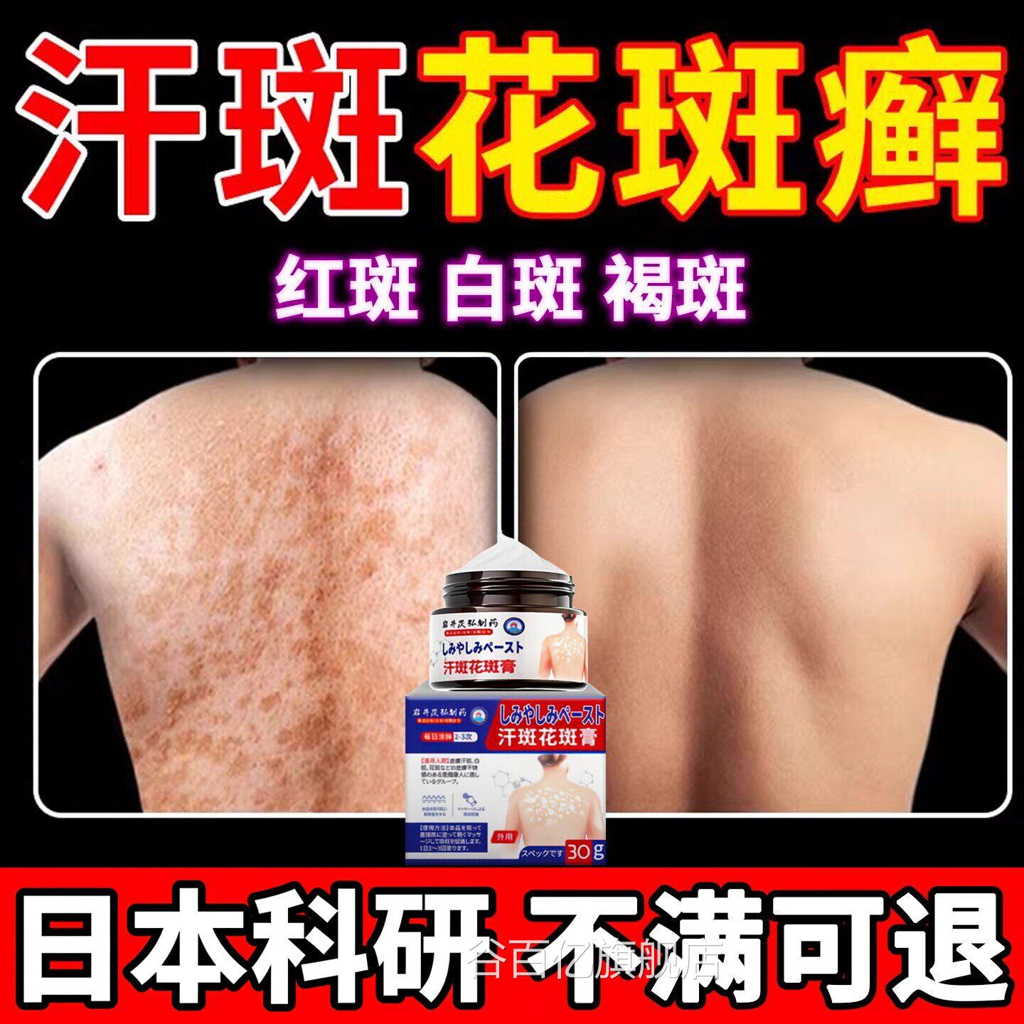 日本汗斑花斑癣药膏快速消白斑喷医用级后背脖子褐斑汗剂斑净克星