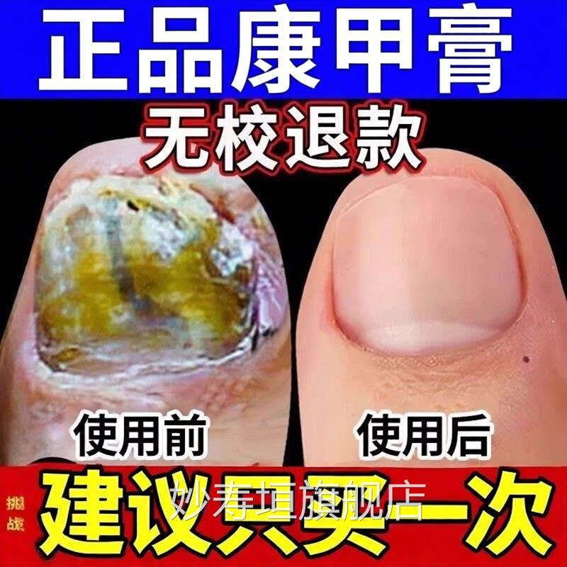 康甲膏官方正品灰指甲趾甲膏植物草本灰甲趾用舒缓脚专用妙寿垣旗