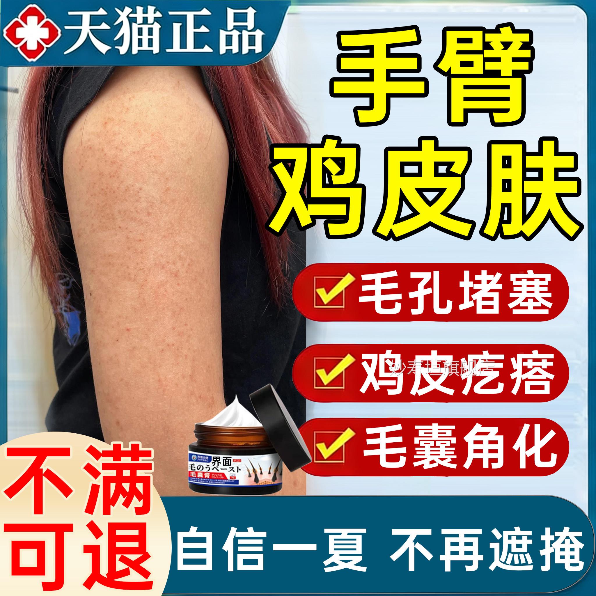 手鸡皮肤疙瘩毛囊角化药膏去除全身臂手臂腿上长疙瘩毛囊炎除螨妙