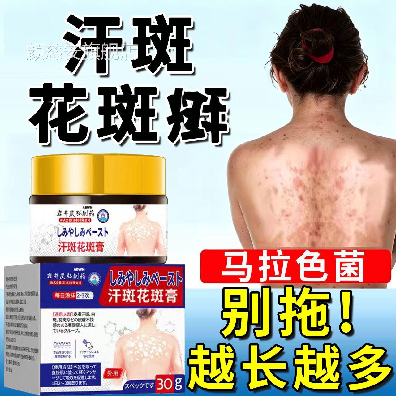 汗斑花斑专背膏用除白斑褐斑真菌马拉色菌感染去癣后消LL颜慈安旗