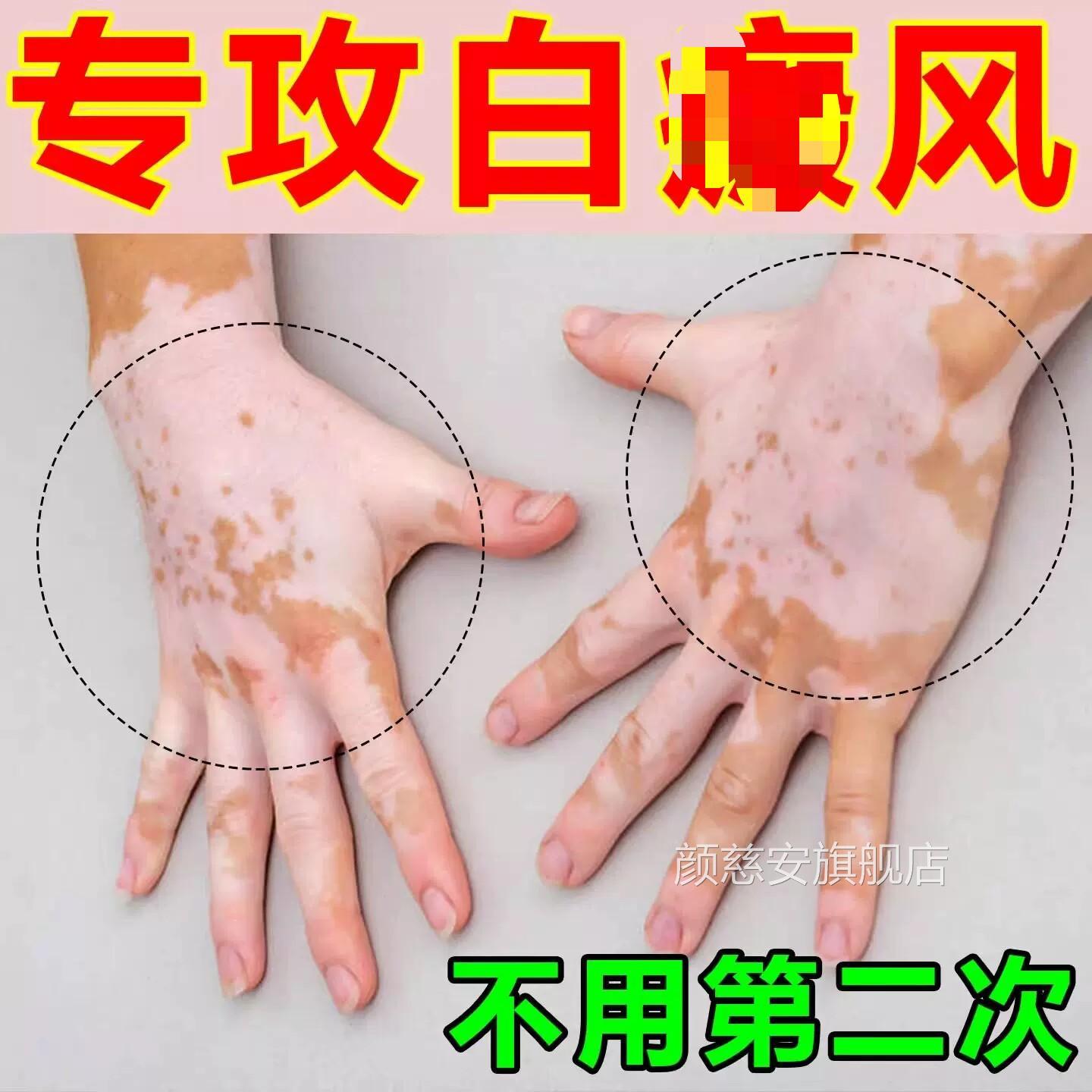补骨脂生酊白癜外用膏黑色素长专用风进口遮盖快速消白斑正品颜慈