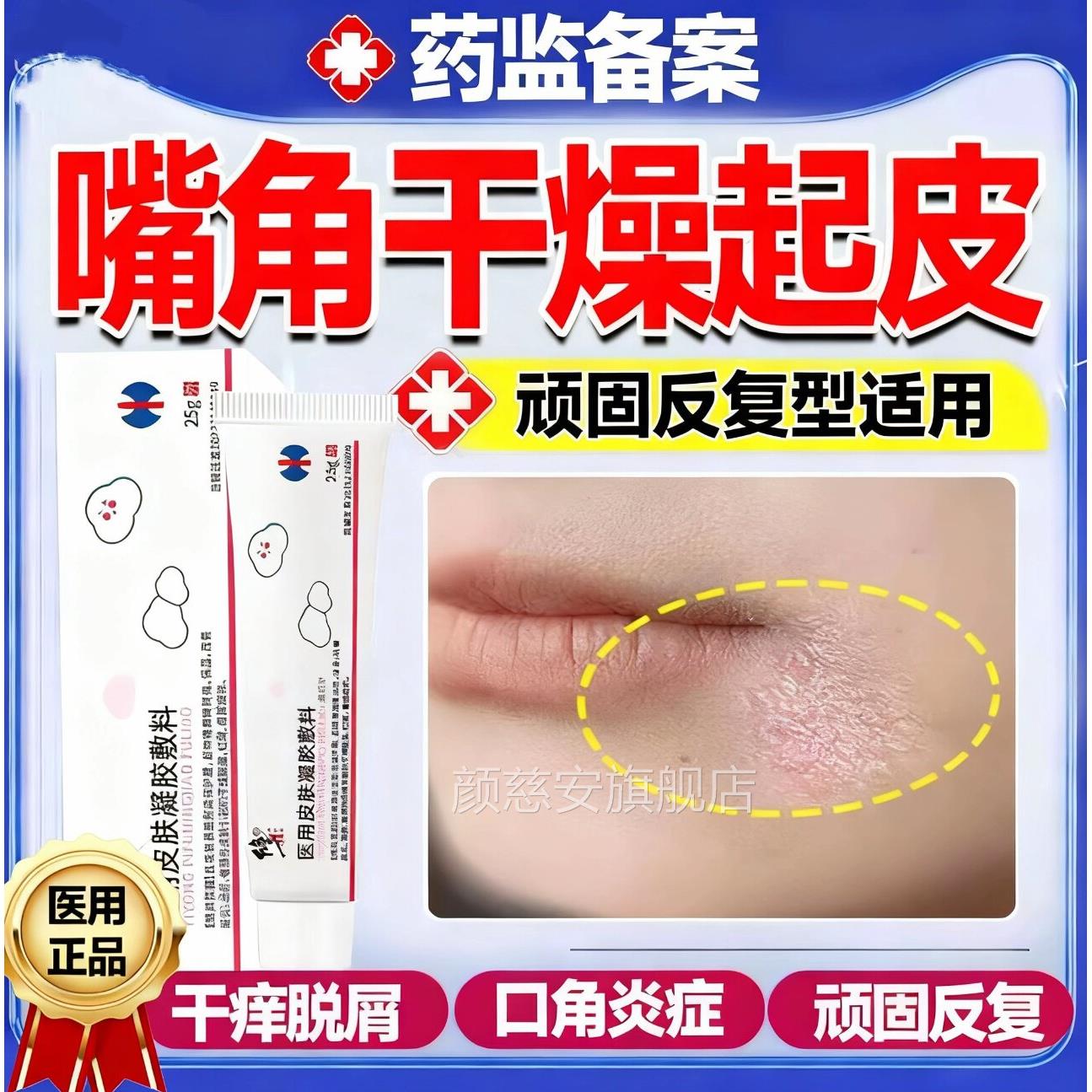 嘴角干燥起皮周皮炎药监备案膏口角炎烂嘴角口癣脸唇上有碎屑干裂
