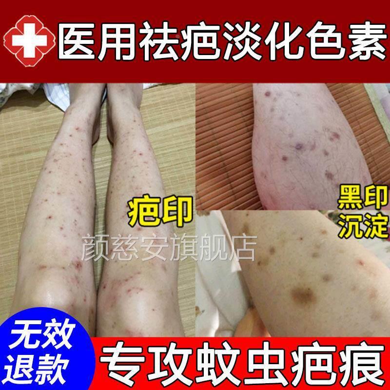 去蚊子叮咬疤印蚊虫祛疤膏除疤痘印疤手术痕修复无痕消印淡化凝胶