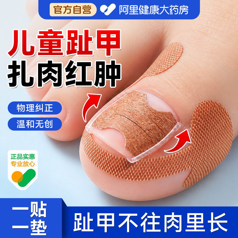儿童甲沟矫正器正甲贴片嵌甲卷甲防脚指甲长肉里纠正器正甲垫片炎