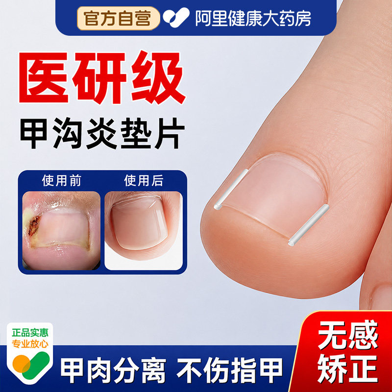 甲沟矫正器炎正甲贴指甲贴片嵌甲脚趾甲往肉里长纠正填充垫片