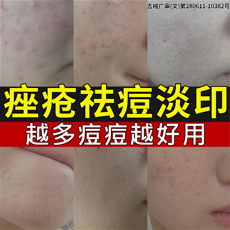 祛痘消炎痤疮专用青少年去痘膏祛痘正品青春痘初中生闭口粉刺YB