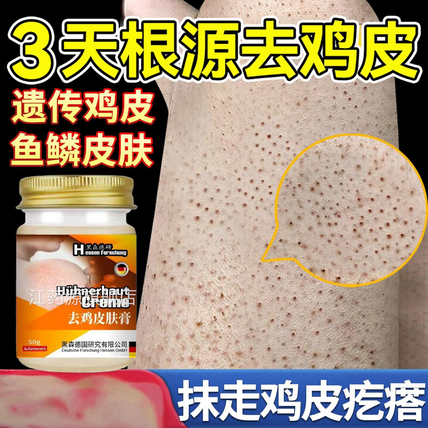 日身本鸡皮肤疙瘩毛囊角化症用膏去除全手臂胳膊腿干燥起皮神器江