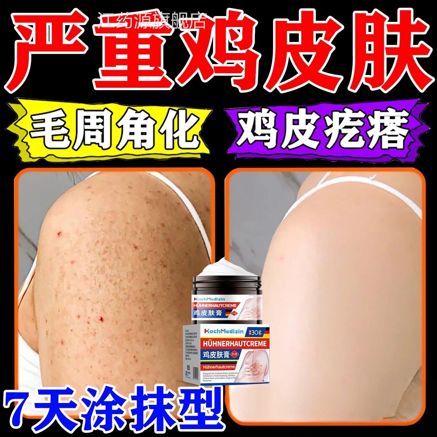 鸡皮肤疙瘩毛囊角化症专除神器全身囊手臂鸡皮大腿部毛炎痘痘江药
